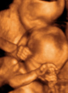 Ultrasound of twin babies